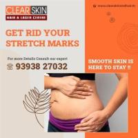 Best Stretch Marks  Laser  Treatment In India