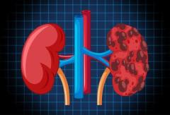 Diabetes and Kidney Disease: Understanding the Connection and Prevention